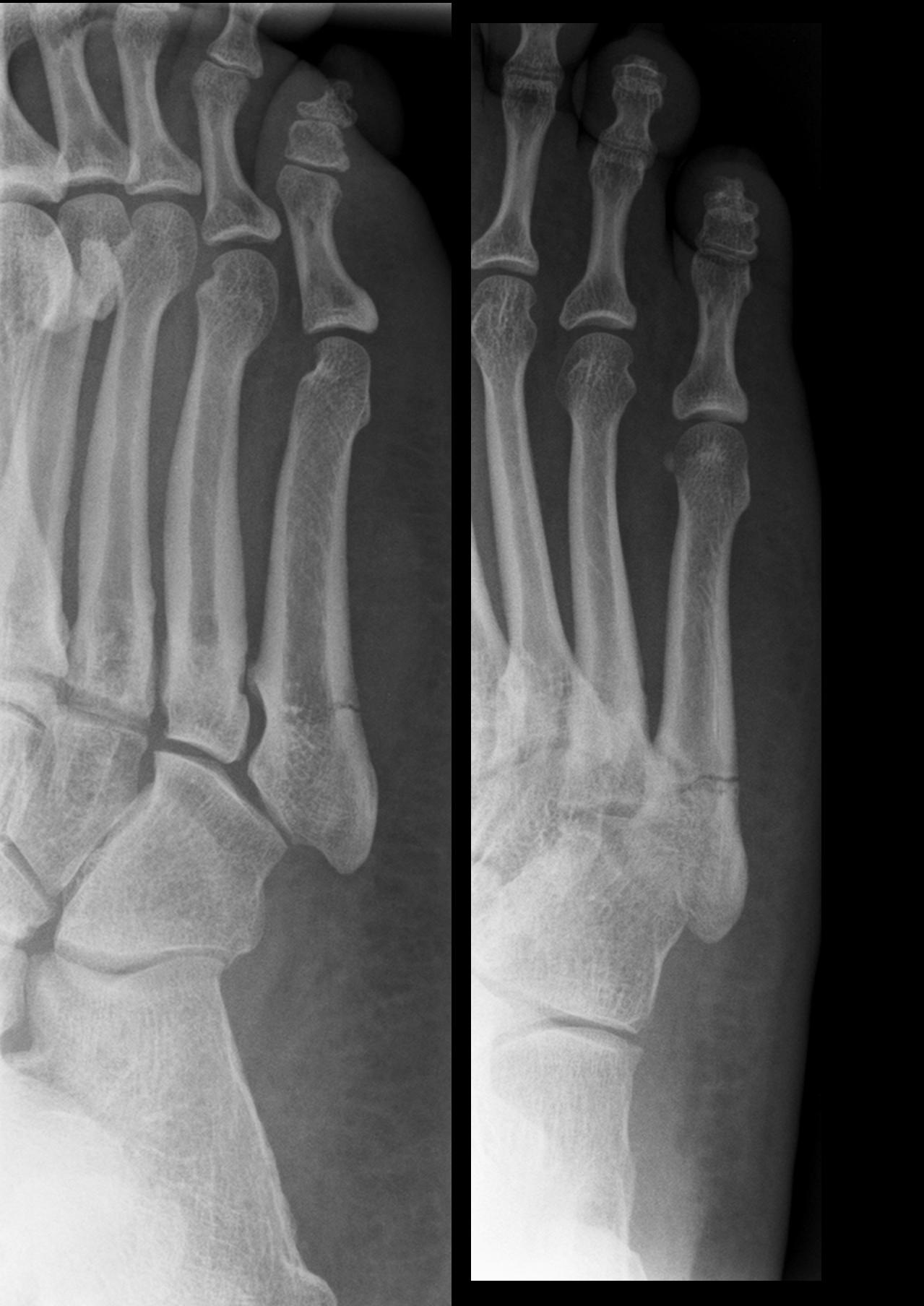 Jones Fracture And Physical Therapy Ace Physical Therapy And Sports Medicine Institute
