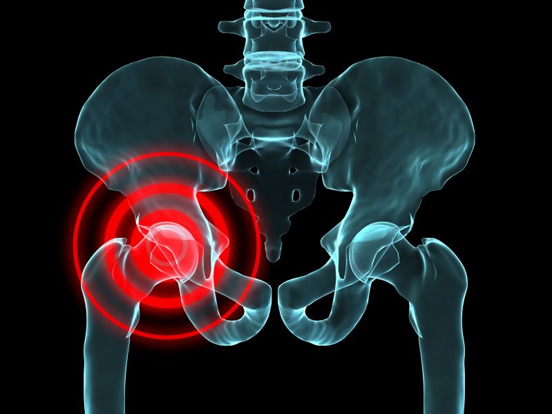 What is inflammation of the soft tissue around the hip?