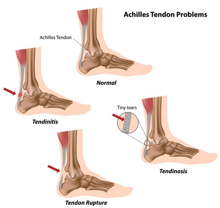 Reduce Injuries Through Essential Ankle and Foot Exercises