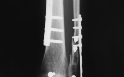 Treating Ankle Fractures