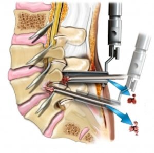 Partial Lumbar Discectomy and Recovery