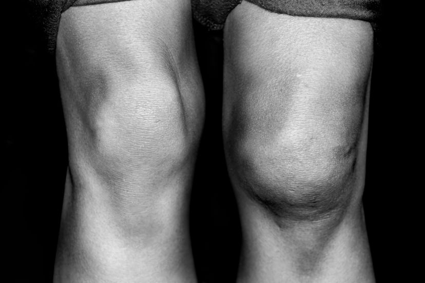 dislocated kneecap pain level