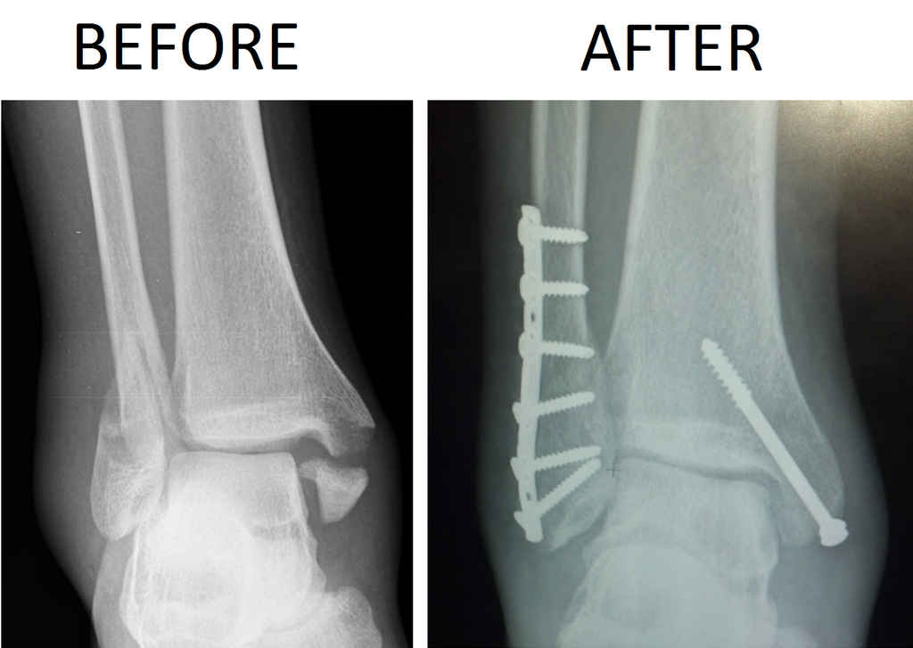 Ankle fracture: diagnosis and therapy