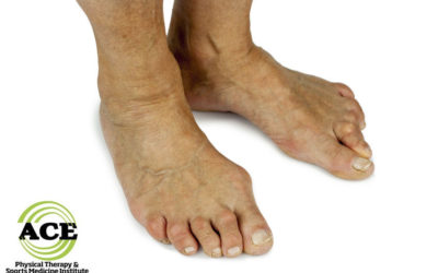 BUNIONS