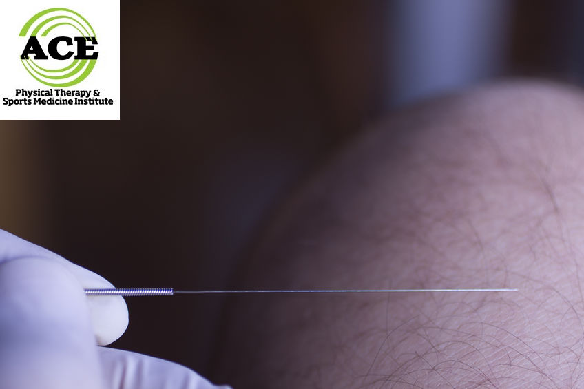 Dry Needling In Physical Therapy Ace Physical Therapy And Sports Medicine Institute
