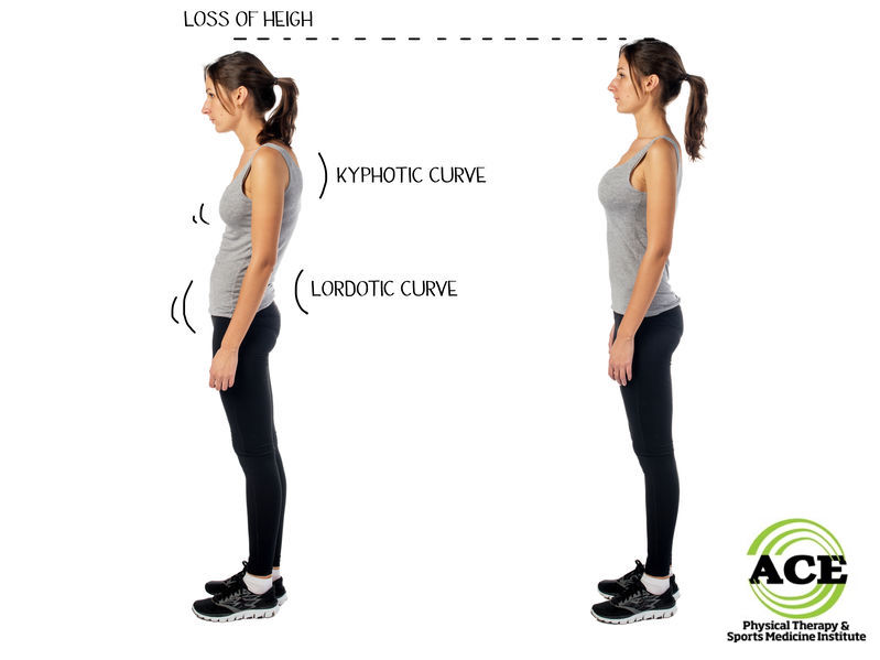 Correcting Posture Is Hard Work That Often Requires Physical Therapy -  Equipoise Physical Therapy
